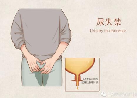关爱女性 | 女性尿失禁问题，不应被轻视